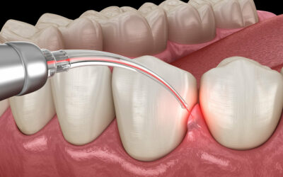 Laser Dentistry – A Modern Way to Treat Your Teeth Comfortable, Precise, Fast.