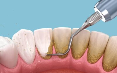 The Importance of Scaling & Root Planing  For Healthier Gums and a Brighter Smile